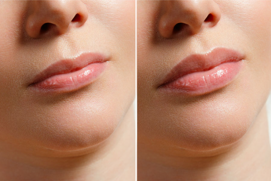 Dermal-Fillers-Image Before and After of a woman with a dermal filler treatment on the lips at Raquel Menezes Aesthetic Medicine - photo in landscape format