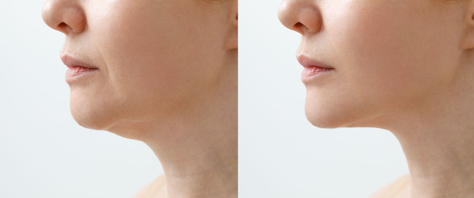 Woman with double chin - before and after