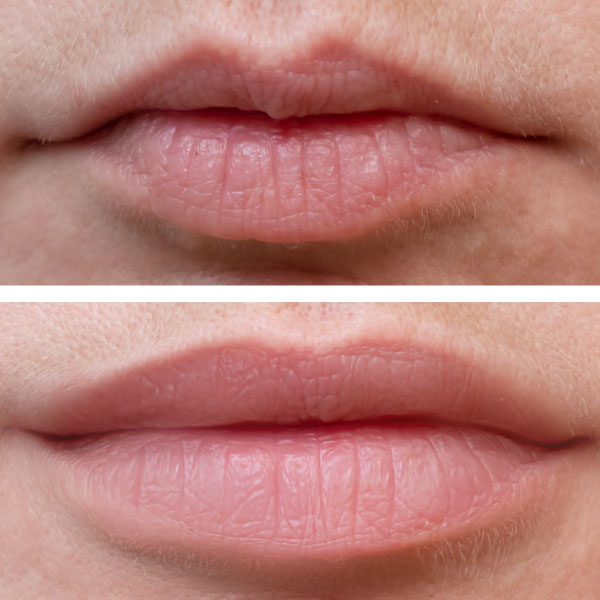 Lip augmentation