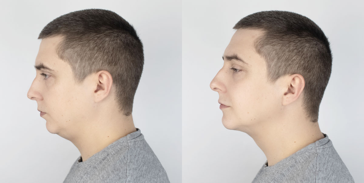 Man with double chin - before and after