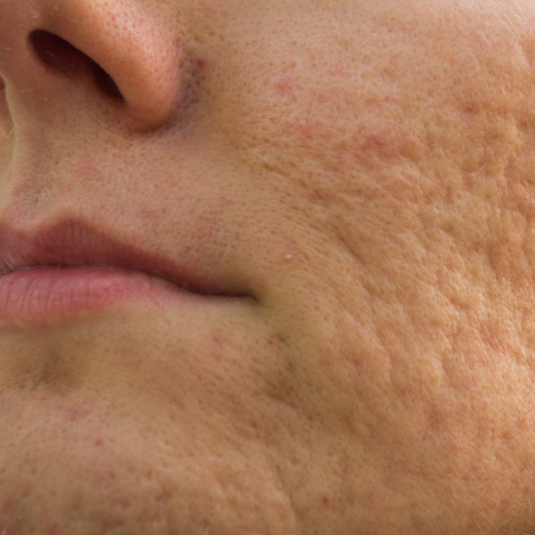 Woman with acne scars.